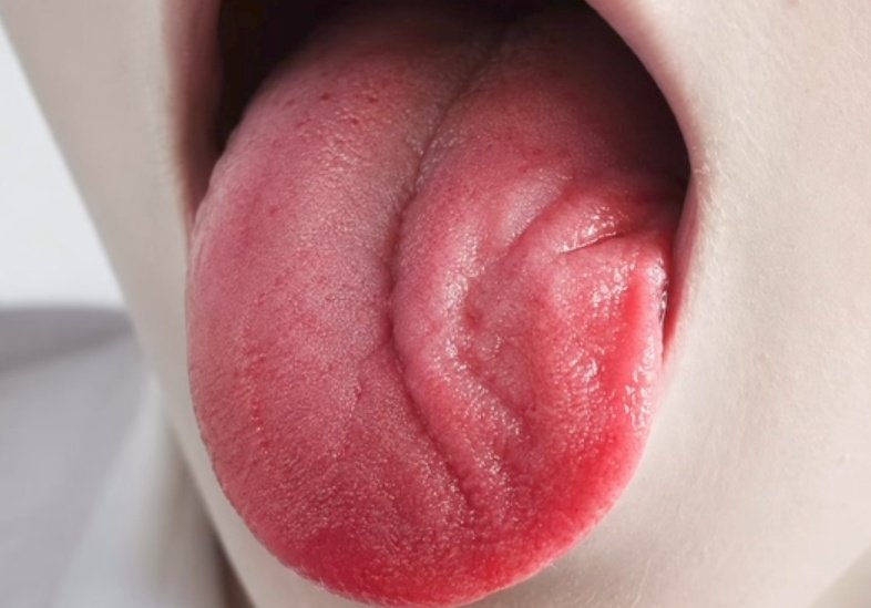 nervemed's tweet photo. Which cranial nerve is affected here❓

A. Hypoglossal
B. Accessory
C. Lingual
D. Vagus https://t.co/dkIuahD8F3
