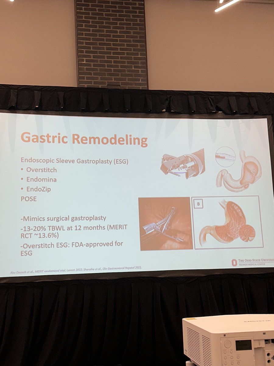 EricaParkMD's tweet photo. Our endoscopy director Dr. Hamza Shah w/ an Endobariatrics 101 this morning, highlighting endoscopic gastric remodeling - exciting cutting edge procedures we are proud to offer at OSU 🌟🌟🌟🌟🌟 @Jarshah4 @OSUWexMed #OSUGHN #OSUAdvEndo https://t.co/iIWgkcMXkj