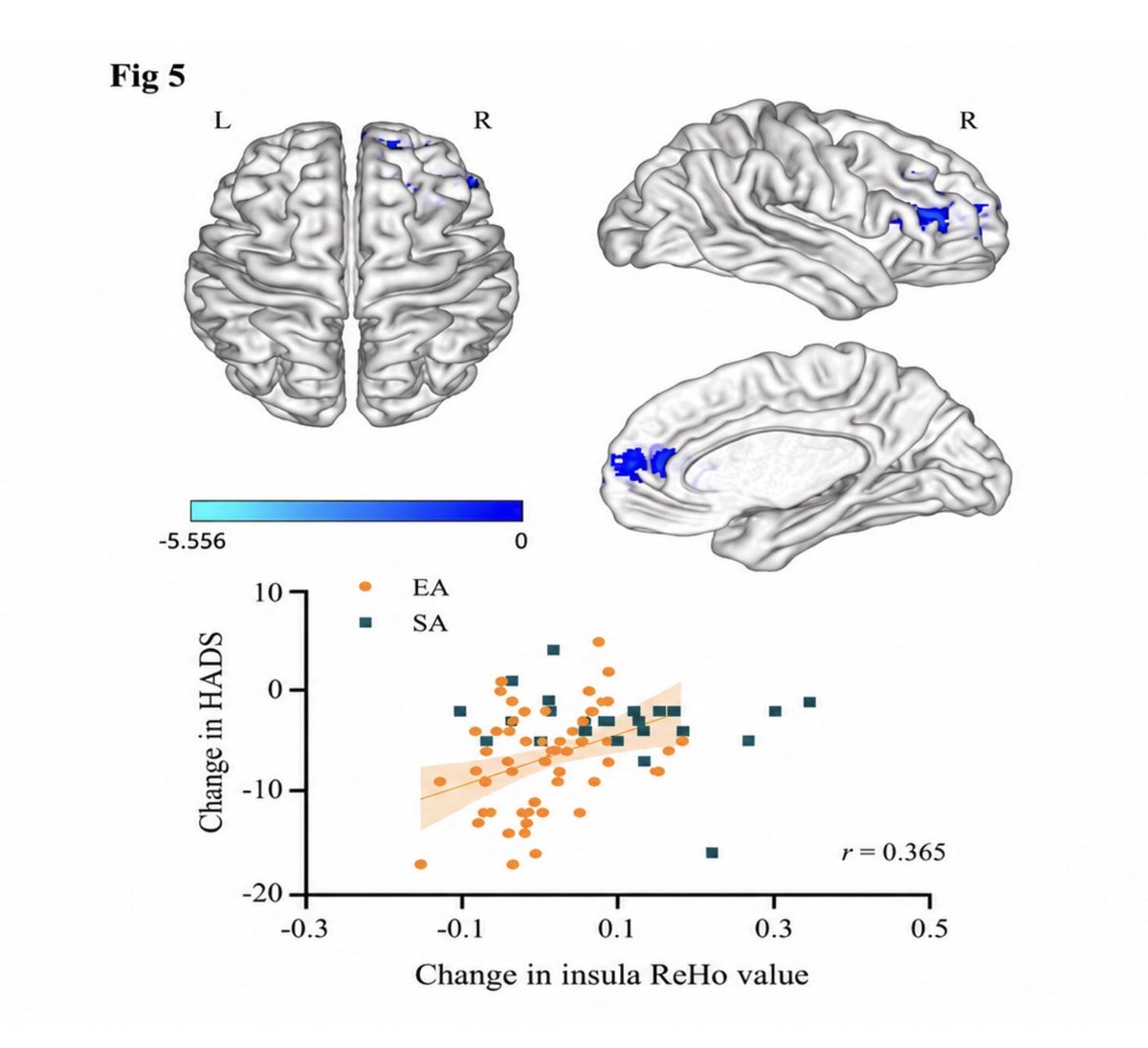 ClinicaBeltranC's tweet photo. Electroacupuntura en tinnitus: RCT con sham muestra mejoría del THI, sueño y ansiedad, con cambios cerebrales medibles en la ínsula. (Zhang Y et al. Complement Ther Med. 2026)
👉https://t.co/Wk0gLbtItF
#acupuntura #tinnitus #acufenos #otorrinolaringologo #clinicabeltrancarrillo https://t.co/HeIHCIJd4z