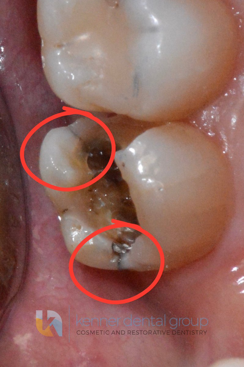 KennerDental's tweet photo. Stress induced fractures noted after removal of an old silver filling.

This is one of the most common findings I see after removal. 

Silver filling material expands slightly as it sets, introducing stress into the surrounding tooth structure.

Because the material is rigid and does not flex with the tooth, it can act like a wedge within the remaining tooth structure.

Combined with years of chewing forces, the surrounding tooth structure can develop cracks and eventually fracture.

Matching materials with properties as similar to enamel as possible, while properly distributing forces, is at the center of biomimetic dentistry.

#BiomimeticDentistryKDG
