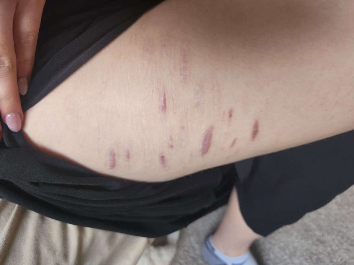 cutiescutz's tweet photo. My dad said no one would notice my scars while we're swimming
Does he think people are idiots🧐🧐?? https://t.co/PzcD5kvPcJ