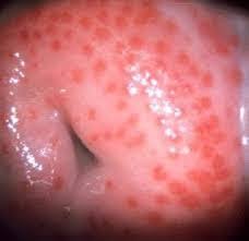 modernHealthMe's tweet photo. A 26 year old woman has frothy yellow green vaginal discharge with itching. On exam, cervix shows a “strawberry” appearance.

Most likely diagnosis?

A. Candidiasis
B. Bacterial vaginosis
C. Trichomoniasis
D. Chlamydia infection https://t.co/0yMQkfbk0T