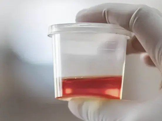 MohmdBio's tweet photo. وش الفرق بين Hematuria وبين Hemoglobinuria في تحليل البول ؟
#مختبرات_طبية https://t.co/hK1CsBaXE2