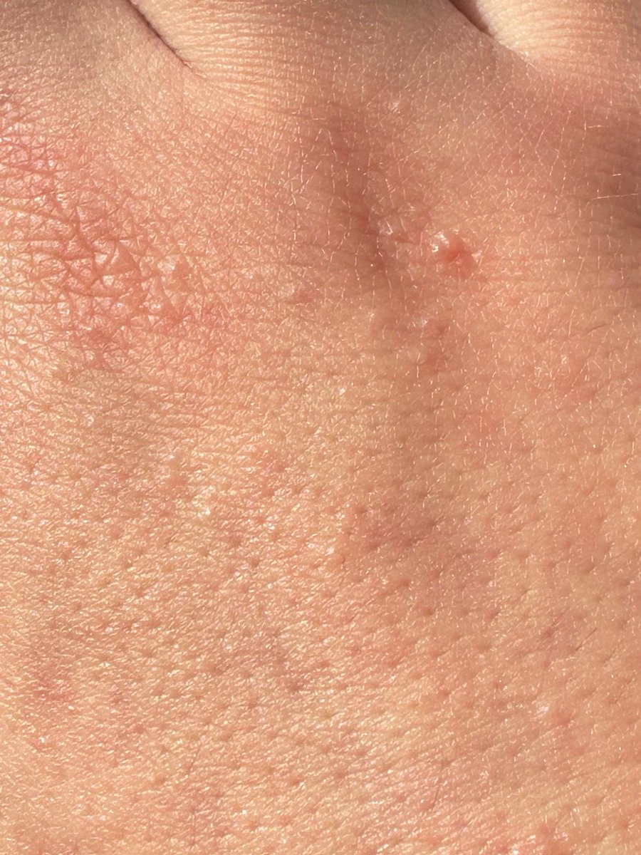Kal_Rahim's tweet photo. J’aurais pu avoir l’air chaud en dermato si j’avais pas la meme chose qd il fait chaud en ete https://t.co/usWPQFEK5r