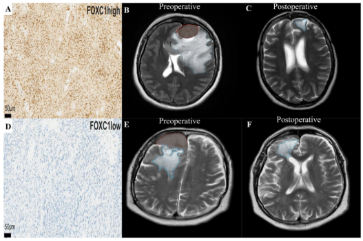 jasonpsheehan's tweet photo. A new study by the University Hospital in Leipzig team published in the Journal of Neuro-Oncology.  They studied FOXC1 and the effects of edema around meningiomas after resection. https://t.co/ISqxn6ca6Z