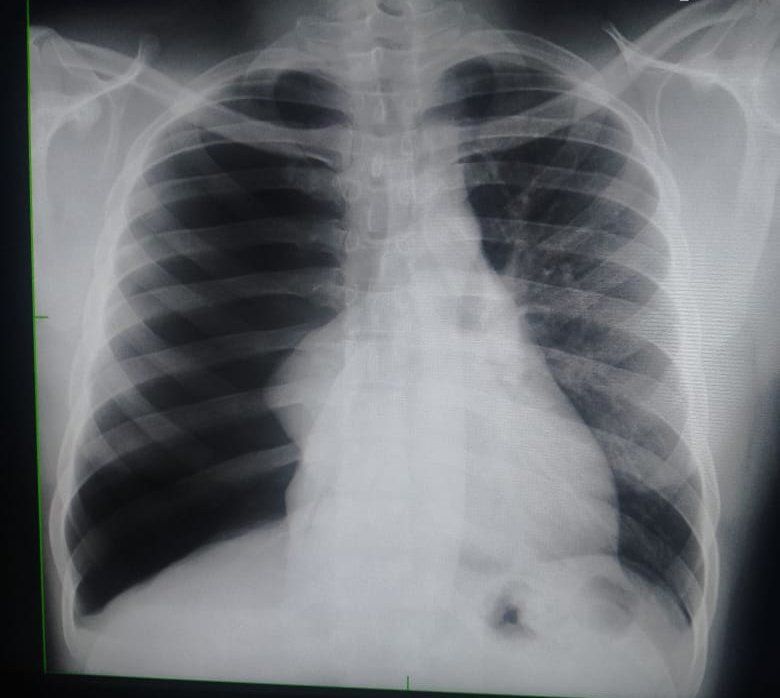 The_Attending's tweet photo. Good for medical education. Before and after intervention for a pathology on the right hemithorax. What are the radiological features of the pathology, what has changed after intervention Typical Nigerian styled questions--vague😁 (pardon the under-pernetrated second x-ray). https://t.co/iI1a1IUxD8