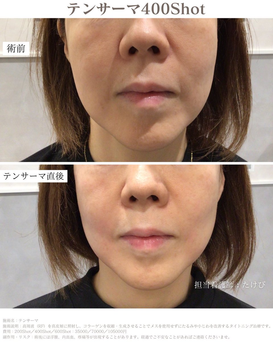 ubkinshicho's tweet photo. 他の高周波（RF）治療で物足りなかった方へ🙋‍♀️

テンサーマは、他マシンに比べて「出力の高さ」が高いです⭕️

強力な熱効率でコラーゲンをガッツリ収縮＆生成させるため、タイトニング効果のモチが違います。このキュッと上がった症例を見てください👏👏👏 https://t.co/AK8p9M4iK9