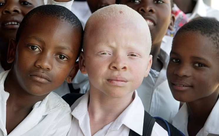 DCharlesiga's tweet photo. As we mark #InternationalAlbinismAwarenessDay, let us #celebrateDiversity, dignity, and #CelebrateAllSkinTones. We are all created unique, and our differences should never be a reason for discrimination but a source of strength &amp; pride.
#IAAD2026 #ProudlyInMySkin #InclusionForAll https://t.co/9AQIpGITKV