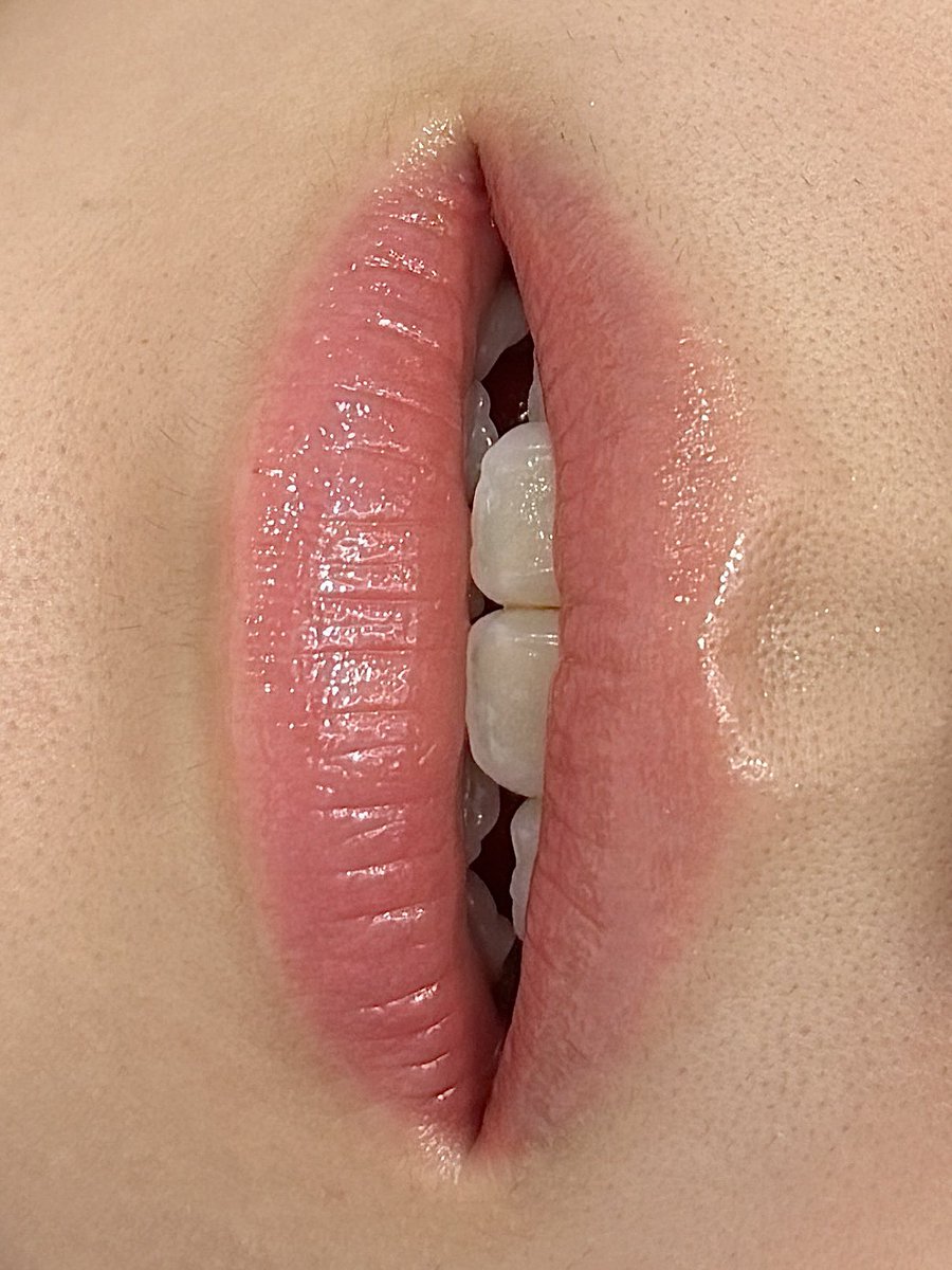 yutzmi_studio's tweet photo. 𝘆𝘂𝘁𝘇𝗺𝗶 リップアート 𝟣𝟩万ウォン ( 現金料金 )

リップアート4ヶ月後
イエローベースのピンクカラーで、
桃のような血色感のある唇へ仕上げます🍑

カラー : ピンク / Pink 
施術所要時間 : 𝟣時間 - 𝟣時間 𝟥𝟢分

予約及びお問い合わせは 𝗟𝗜𝗡𝗘でお願いします.ᐟ
https://t.co/bW2UiLIarT

▪️理想的な唇の割合のための 𝟣:𝟣のオーダーメイドデザイン
▪️お好みのカラーと肌唇の色を考えたカラーレシピ
▪️𝖨𝖲𝖮及び𝖢𝖳𝖫認証された安全ビーガン色素を使用
   （施術後 𝖬𝖱𝖨 撮影可能）
▪️使い捨て滅菌ニードルの使用後、直ちに廃棄
▪️安全で衛生的な空間で入念な施術実施

リタッチカラーの金額案内 

▪️初施術後𝟥ヶ月以内の訪問時𝟧万ウォン 
▪️初施術後𝟨ヶ月以内の訪問時𝟣𝟢万ウォン
     ( 施術項目当たりの金額です )

追加割引のご案内 

▪️同伴予約時 𝟣万ウォン追加割引 
▪️同伴施術可能 ( 所要時間別途お問い合わせ ) 
▪️同時施術の可否は別途お問い合わせください

#リップアートメイク #唇アートメイク #リップブラッシュ #韓国アートメイク #アートメイク #落ちないリップ #半永久メイク #ティントリップ #美眉 #韓国 #ソウル #渡韓 #韓国旅行 #韓国留学 #韓国美容 #韓国整形 #リップアートメイクおすすめ #リップアート #フルリップ