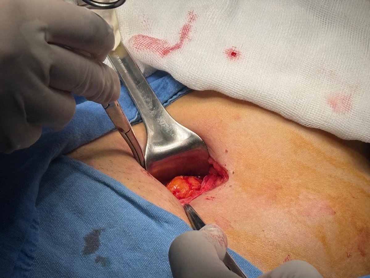 CMQ_Torres's tweet photo. Femenino de 49 años con Hernia Inguinal operada sin complicaciones con colocación de malla.

Citas: 2229633387📱 https://t.co/bx4vhNlLCv