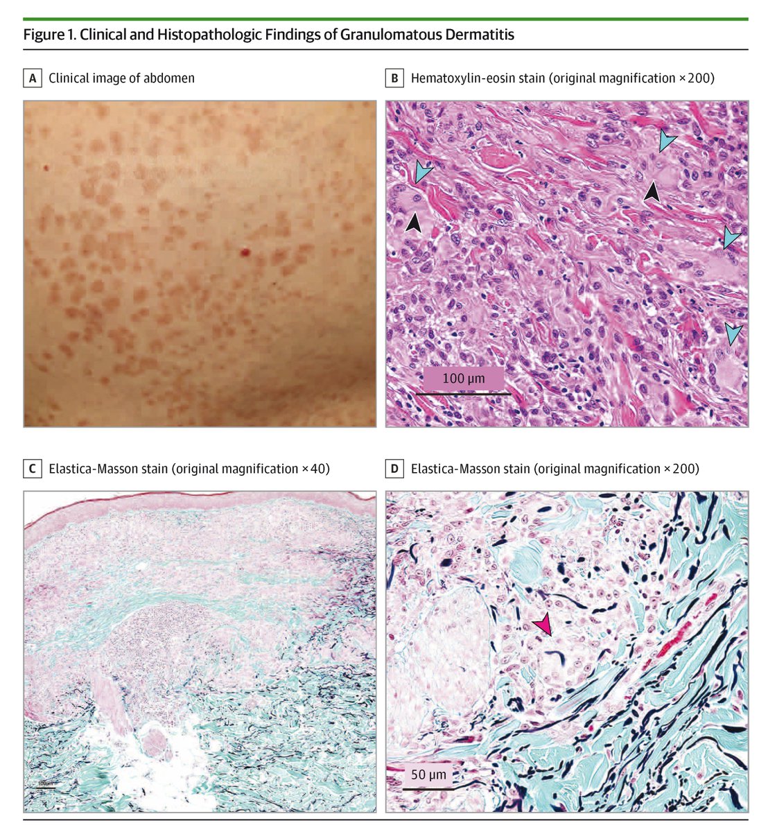 JAMADerm's tweet photo. 📃 Case report describes a man in his 90s with granulomatous dermatitis successfully treated with topical delgocitinib. https://t.co/BFVjwRyHTV https://t.co/3C48Nd99fV