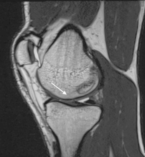 jbjs's tweet photo. "Progressive Osteochondral Defect of the Medial Femoral Condyle in a Collegiate Football Player" by Rizk et al.
Read the full article π https://t.co/g3ce3p3sbw
#JBJS https://t.co/zfMS5IWeBC