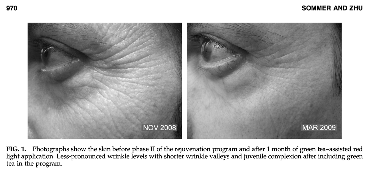 Outdoctrination's tweet photo. Red light + green tea powerfully reduces skin aging in clinical trial.

This is one month of progress utilizing:

◇ Green tea filled cotton pads applied to the face
◇ 670 nm red light

For 20 mins per day.

Both tools work on the key paths found in skin aging - collagen/elastin preservation + synthesis, reduction of ROS.