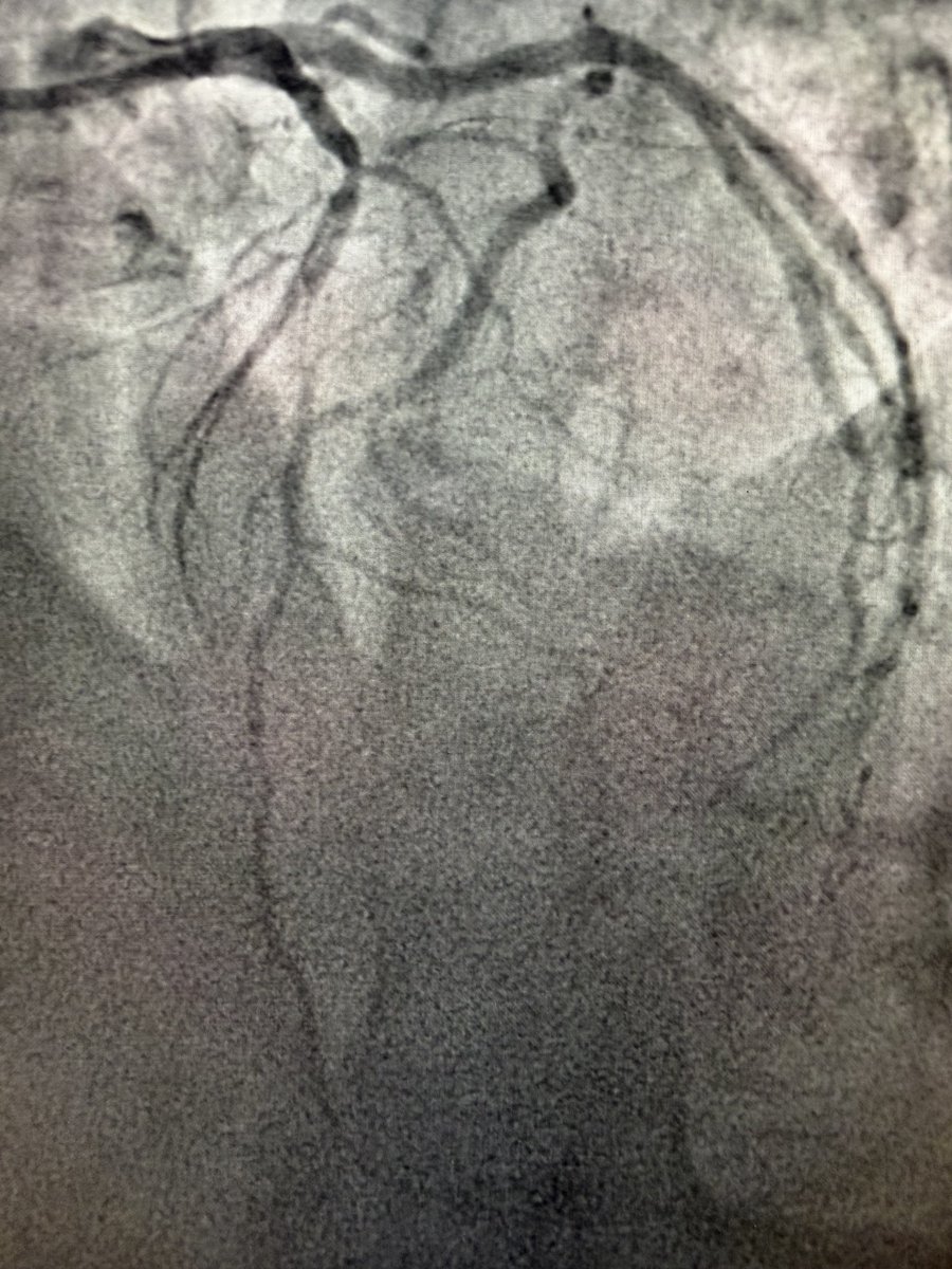 Hragy's tweet photo. F60,poorly controlled DM, NSTEMI, Tn HS 1000 (ref range 14) bilateral diabetic foot,high BMI, on NOAC for DVT, #RadialFirst your thoughts on this LAD? Heart team decision in hospital=PCI
Those are the patients we face in real life everyday practice. https://t.co/fwtzGgSgl6