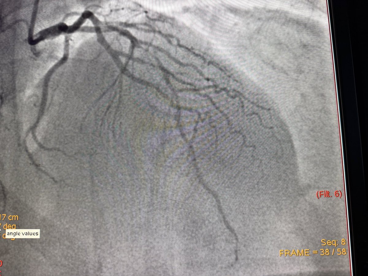 Hragy's tweet photo. F60,poorly controlled DM, NSTEMI, Tn HS 1000 (ref range 14) bilateral diabetic foot,high BMI, on NOAC for DVT, #RadialFirst your thoughts on this LAD? Heart team decision in hospital=PCI
Those are the patients we face in real life everyday practice. https://t.co/fwtzGgSgl6