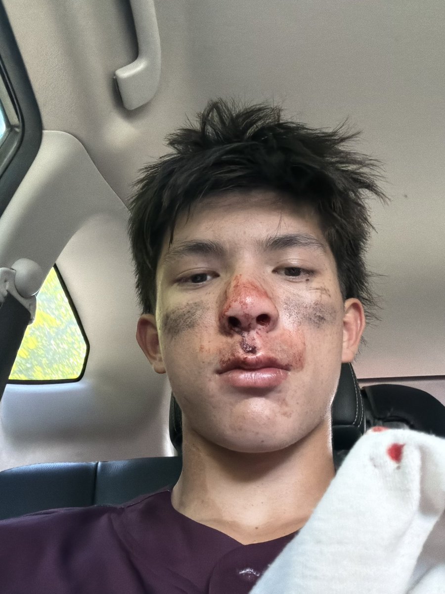 AlfredPresten's tweet photo. Not the weekend I had planned. Took an 86 MPH pitch to the face and broke my nose. Tough break, but I’ll be back soon. Focused on recovery and getting back on the field. Thanks for all the support. https://t.co/fyKcfiOcNp