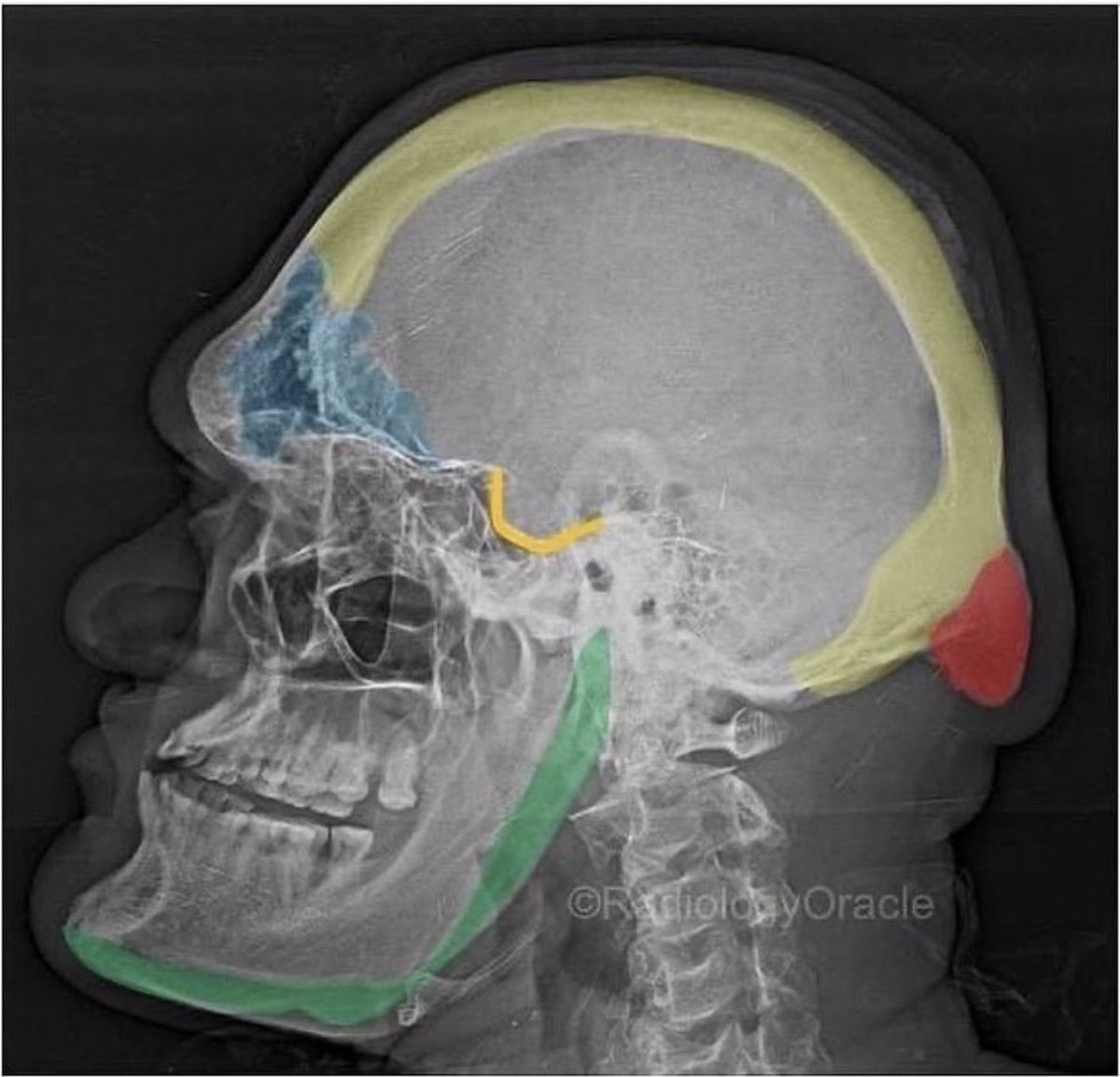 unkleturd's tweet photo. @FeelsGuy2003 Bro gave himself acromegaly from abusing hgh https://t.co/c889AxoayV