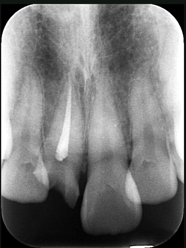 pic_teeth's tweet photo. x線写真 https://t.co/P4TI67XVhH