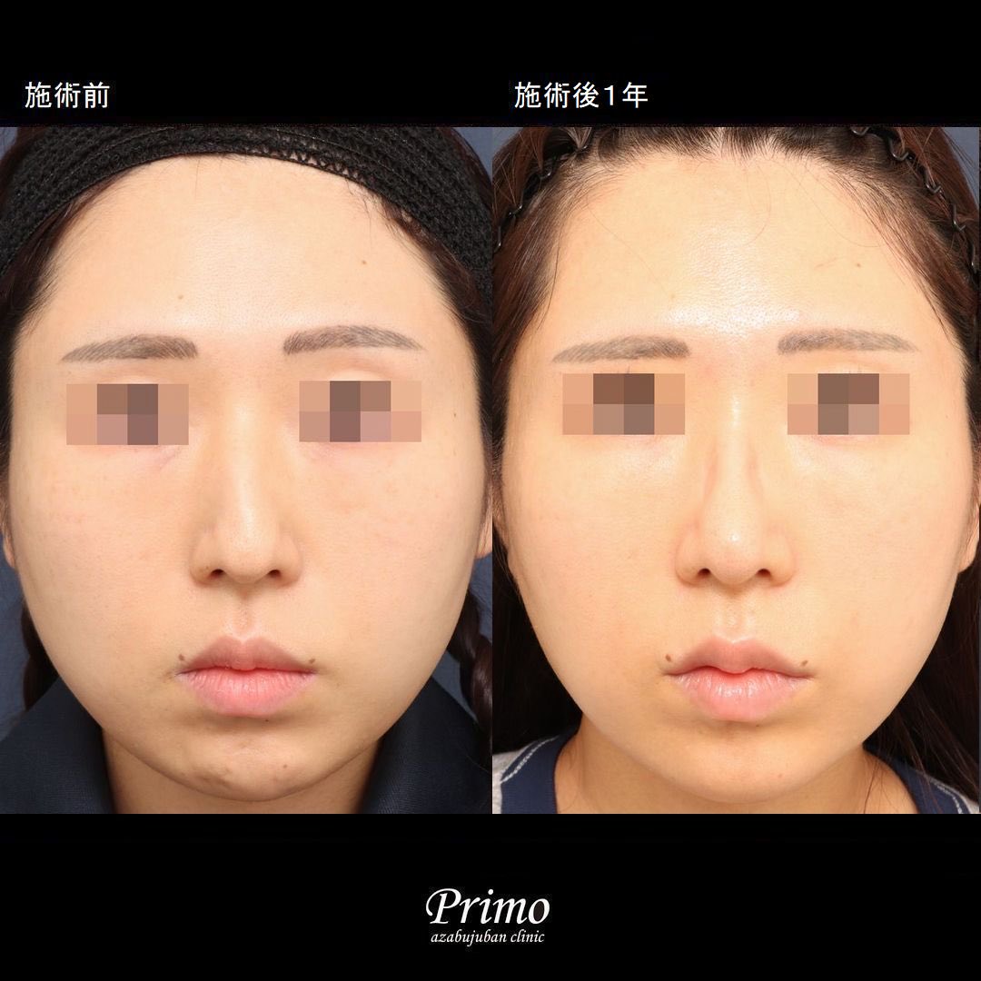 primoclinic's tweet photo. 鼻中隔矯正術＋鼻中隔延長術＋整鼻術＋鼻尖形成術＋口角挙上術を行いました。

術前の鼻は、ハンプが大きく、鼻先がやや垂れた印象でしたが、鼻中隔延長術+鼻中隔矯正術+整鼻術を行うことによって、ハンプは小さくなり、鼻先が高くバランスが良くなりました。
 
・費用
鼻中隔延長術　　　　　　　　￥660,000
整鼻術　　　　　　　　　　　￥660,000
鼻中隔矯正術（セット割引）　￥440,000
口角挙上術　　　　　　　　　￥330,000
 
・リスク・副作用
腫れ、内出血、鼻出血、鼻づまり
鼻柱の傷跡
鼻先、耳介の知覚低下
鼻の傾き、段差、左右差
鼻尖部の挙上ができない
肥厚性瘢痕
口唇形態の変化

プリモ麻布十番クリニック