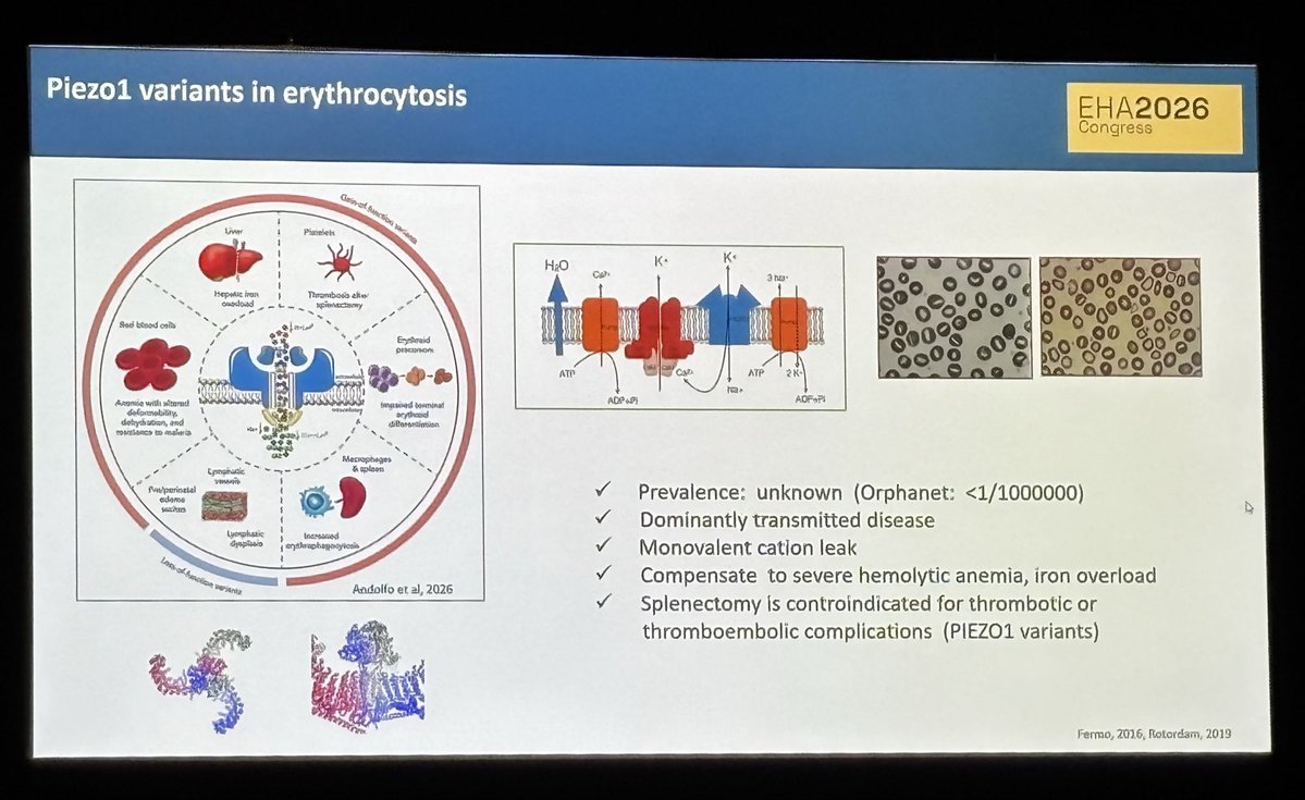 MiguelGmAl's tweet photo. Cada vez más prevalente en nuestras consultas… la eritrocitosis, su complejo diagnóstico diferencia, PIEZO1 y las dudas sobre cómo manejarla en la #EHA2026. ¿Cómo los categorizamos y cuándo hacer flebotomías? 

#HEMandNET #HematoEnRed #Hematología @sehh_es https://t.co/1Xd1BSv4tu