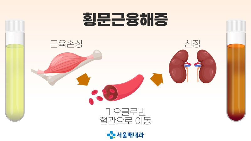 Qudckarhk's tweet photo. 이거 좀 더 자세히 쓰면은

-오줌이 적~갈색이 된다
-근육통이 너무 심하게 오래 간다
-무기력하고 뭔가 근력이 약해지는 거 같다

바로 병원으로 가서 본인이 물과 이온음료, 당분 보충 없이 5km를 뛰었다고 말씀하세요.

추가로 심장이랑 신장에도 엄청난 무리가 갔을 테니까 다들 무조건 안정입니다 https://t.co/Xvm7LydrOt