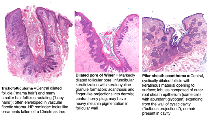AAlhatem_MD's tweet photo. #Dermpath for #Residents - Trichofolliculoma vs Dilated pore of Winer vs Pilar sheath acanthoma #pathology #dermatology https://t.co/R68mgrcv8q