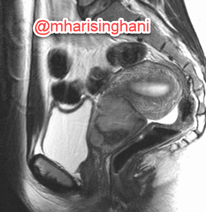 mharisinghani's tweet photo. Cervical lymphoma https://t.co/gO9dlTUPcZ