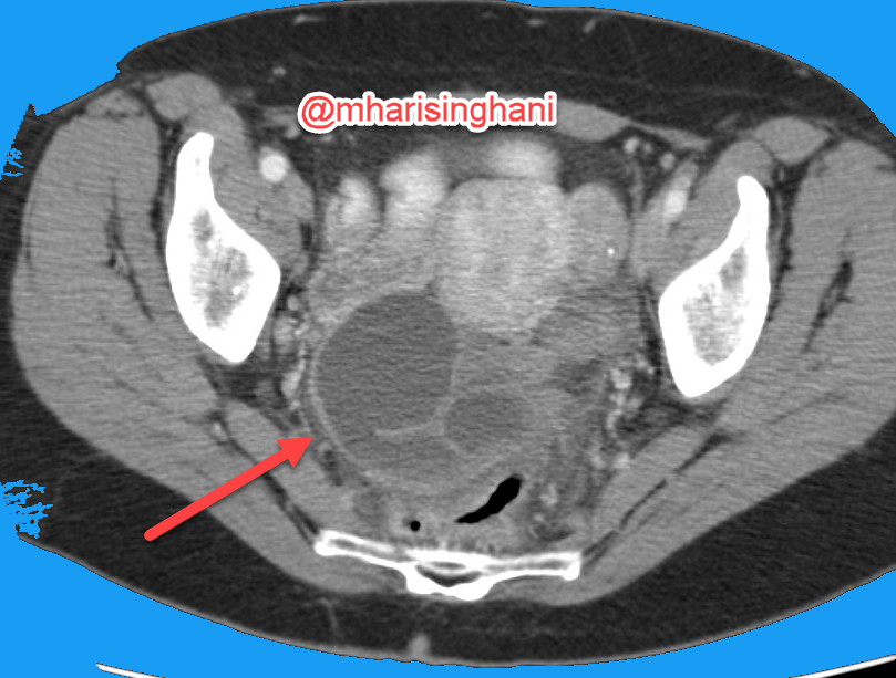mharisinghani's tweet photo. CT appearance of pyosalpinx https://t.co/girkSdlHwa