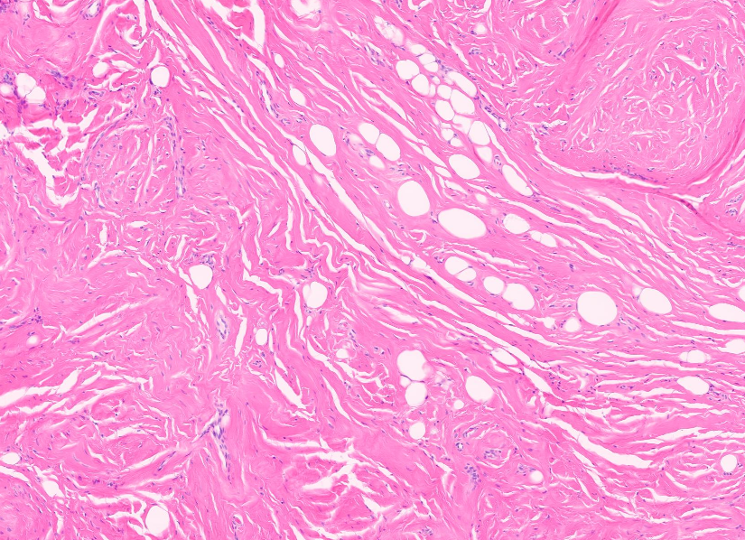 Janiranavarro's tweet photo. Foot lesion in a patient with tuberous sclerosis
Final diagnosis
Fibroma-like PEComa

This case was originally signed out descriptively and favored to represent a nonneoplastic process. Subsequent discussion with the surgeon revealed a history of tuberous sclerosis. PEComa markers were then performed and were positive, supporting the diagnosis

Dr. Fritchie. Comprehensive and Immersive Soft Tissue Pathology Course 2026  #pathology #PathX #PathTwitter
