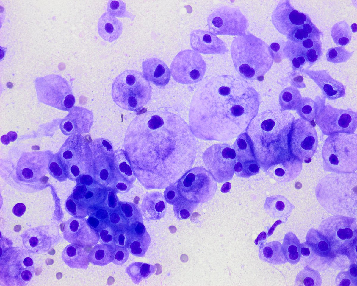 pepeheffernan's tweet photo. CC391. Gloomy Sunday case. Organ and diagnosis? When I show you the histological image (the day after tomorrow), it might become clearer to you. In my opinion, few tumors—if any—look like this after FNA of a XYZ tumor (adult). In a few years AI will spot it in seconds #cytopath https://t.co/Exm59XFhSL
