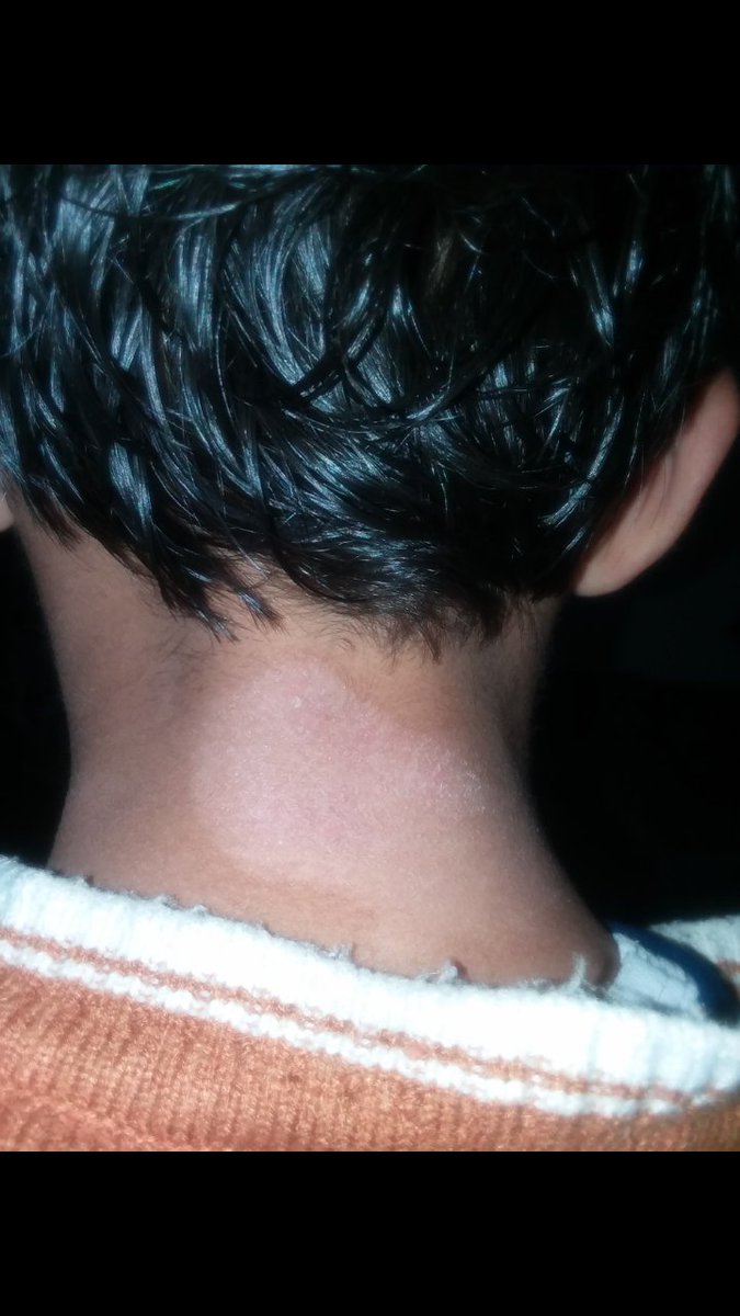 sanaa06452029's tweet photo. اي شخص مصاب باحد الامراض الجلديه الموضحه في الصوره 
او يعاني من زوائد لحميه 
او مايسمى بالشمانيا الي ياكل الانف او الخد 
عندي علاج مضمون ادله عليه 
عباره عن سائل من نبته طبيعيه
والي متعافي ينشر لعل الله يشفي شخص على يديه 
ولايتواصل معي الى من هو مصاب ويرغب بالعلاج https://t.co/l6rPgRooTs