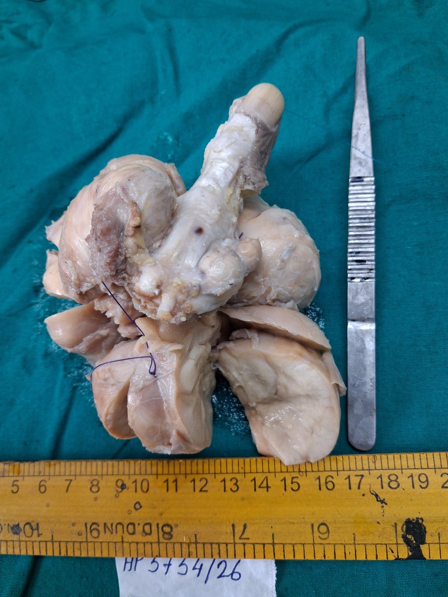 ArghyaBandyopa5's tweet photo. 55 years male, agriculture worker by profession, presented with mass lesion in left hand. He had no lesion in nose or nasopharynx. Thank you. https://t.co/jE2NOPgzjv