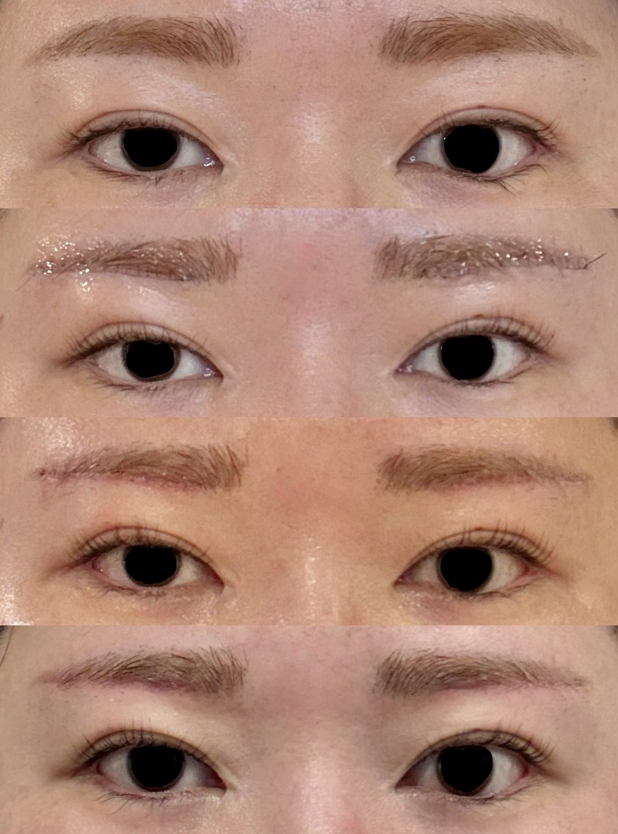 shogun_abare's tweet photo. 眉下切開DT 術後2週間🥸

傷跡は赤い線になってて不安はあるけどメイク後は本当にわからない…！✨
傷の凹みと上下の盛り上がりは変わらず！
今のところ十分及第点という感じで満足🥲

📸 
①上からビフォー、当日夜、抜糸後、今
②上抜糸前、下今
③たるみの変化

#整形垢さんと繋がりたい  #眉下切開 https://t.co/rn7YLXGSNj