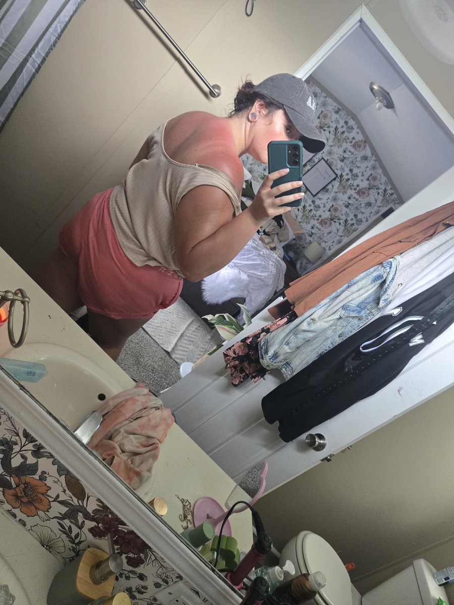 itsmeshaunie's tweet photo. Remember kids:

Sunscreen is your friend 😪 https://t.co/uOmJXrF4KE