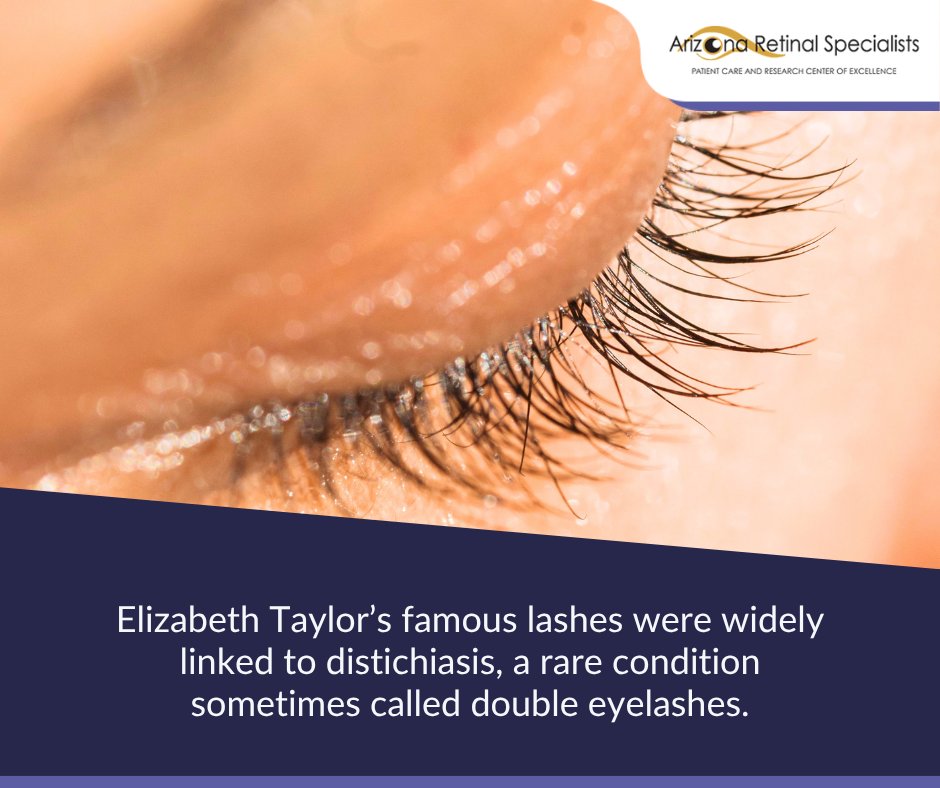 azretinal's tweet photo. While it can make the lash line appear fuller, distichiasis can also irritate if the lashes rub against the eye. It is a fascinating example of how eye anatomy can shape both appearance and eye comfort. https://t.co/tmAJlmU3qy