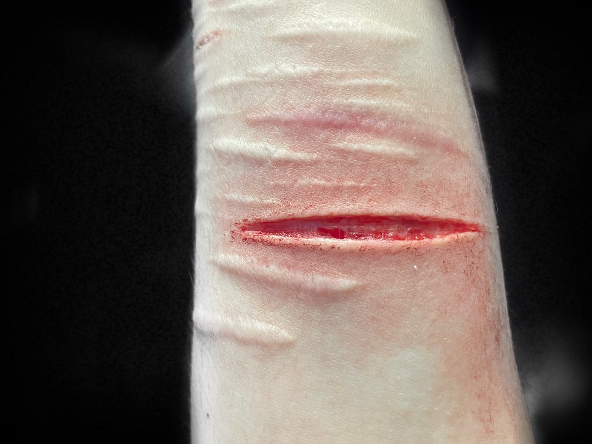 itriedallalong's tweet photo. small sesh on my left wrist, i got interrupted.
⦻ FAKE SFX MAKEUP!
#SELFHARMTRIGGERWARNING
#sh #shhtwt #selfharm
#slittwt #shed #shedtwt #988shtwt #beans #babybeans #scarspo #988twt https://t.co/T3vTKOtlil