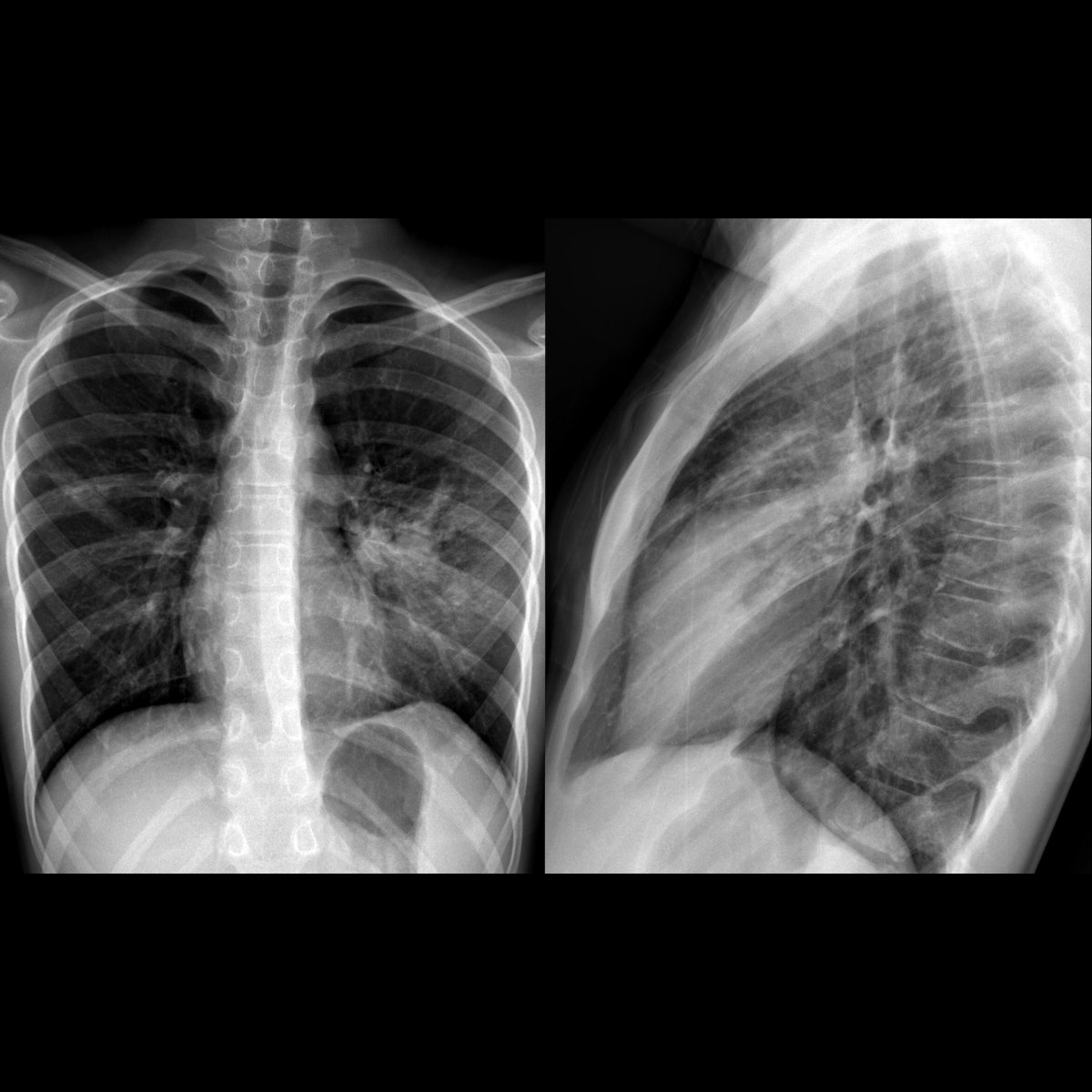 pedsimaging's tweet photo. School ager with fever+cough for 1 week
CXR PA(left) shows opacity in lingula that is obscuring the left heart border (silhouette sign)...
#FOAMed #MedEd #FOAMRad #PedsRad #RadEd #pediatrics #EmergencyMedicine #radiology #medstudent #medicalstudent #paediatrics #pediatria https://t.co/UI60ZSF4Wp