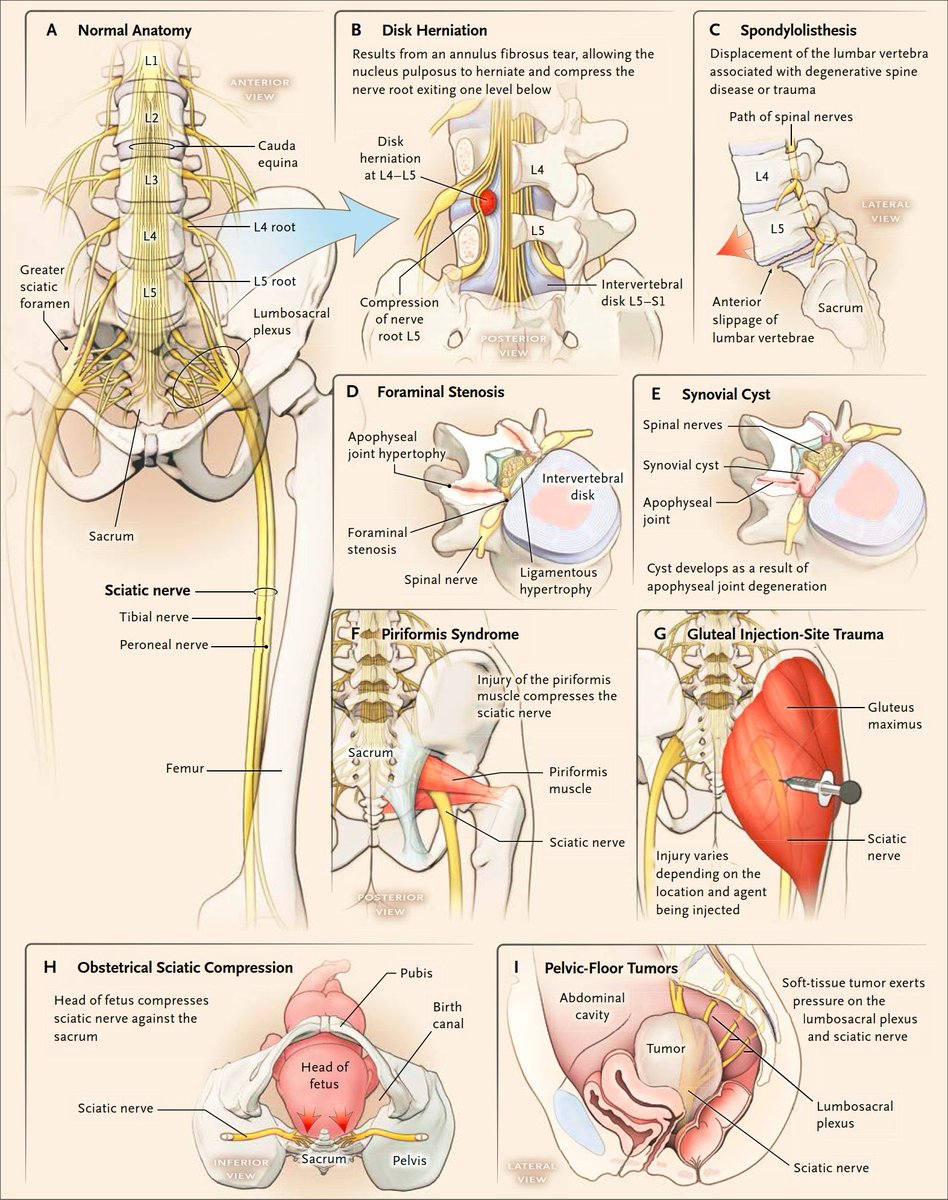 TrackYourHeart's tweet photo. Sciatica: Anatomy, Causes, and Mechanisms https://t.co/TG9qBZARaD