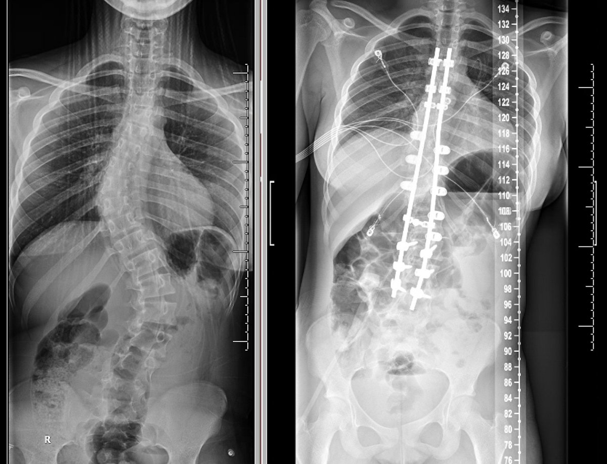 OUbabybrainMD's tweet photo. An all-pedicle screw construct that may increase cost, hypokyphosis, and PJK. We (arguably) obtain the same outcomes with a hybrid construct and translation of the deformed spine: pedicle screws at the foundation; polyester bands at the apex; and hooks at the top. https://t.co/wsMA3s9j1o