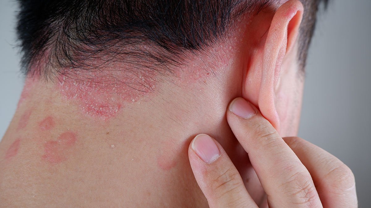 1PassionPoint's tweet photo. Hey @grok What is Psoriasis: Symptoms, Causes, Types, and Treatment

This problem arose when my girlfriend and I slept together one night. https://t.co/QldvvyHGGK
