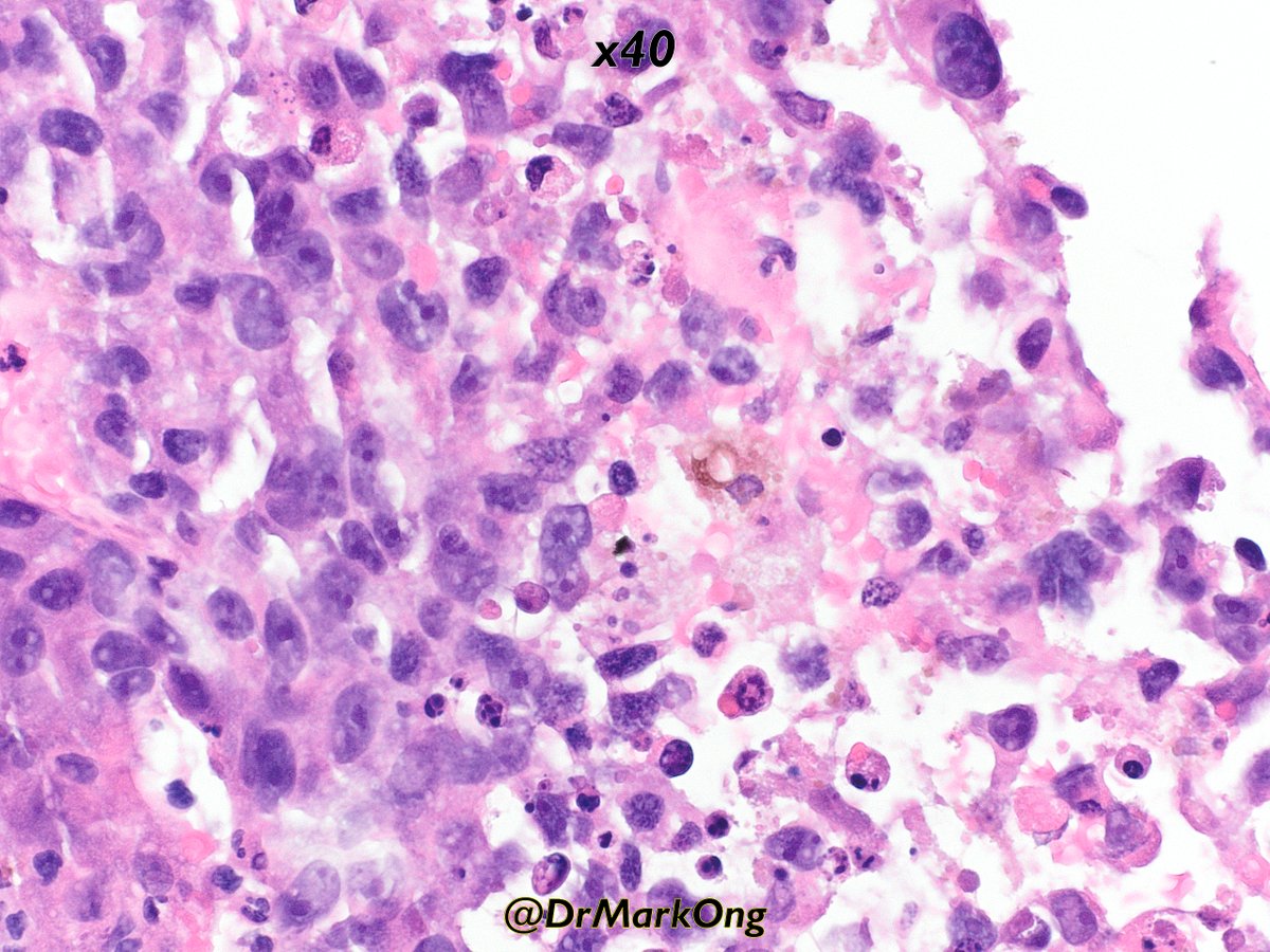 DrMarkOng's tweet photo. Biopsy of abdominal mass in elderly male with disseminated disease on radiological imaging.

Immunohistochemistry in next post.

What's your preferred diagnosis?

#GIpath #pathology #pathX #pathtwitter https://t.co/KYA7aiH8wj