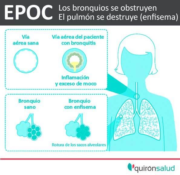 Respira_sano's tweet photo. No sólo el #tabaco es la causa de #EPOC. También la contaminación, la inhalación de polvo o productos químicos y alteraciones en el desarrollo pulmonar en menores. https://t.co/vl9e48haUo https://t.co/mLJcBlnE9x