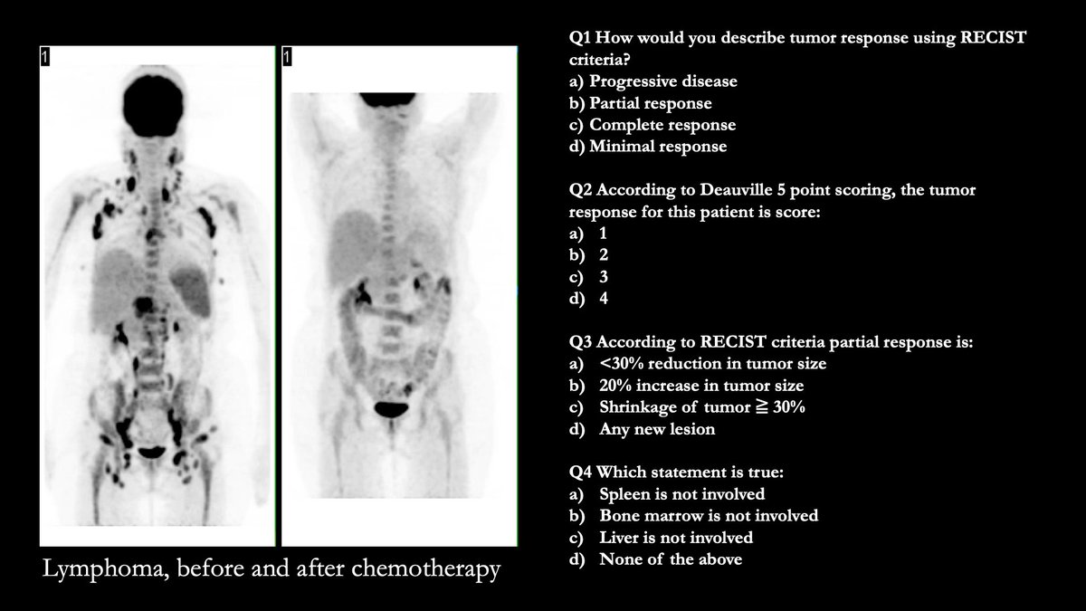 NuclearMD's tweet photo. Case Challenge: # 70
Test your skills by providing answers in comments.  Come back to check the answer key in 24 -48h. 
Get all the cases at: https://t.co/xWiTQdHGvq 
#Radiology #nuclearmedicine #petctscan #nucmed #radres https://t.co/XCyCP6fYwv