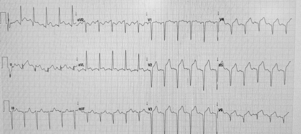 OnlyEcg1's tweet photo. Chest pain.  Culprit 🫀?

#Cardiovascular #MedTwitter #CardioTwitter #MedicalEmergency #MedicalStudents #MedicalEducation #EKG #ECG #Paramedics #STEMI #OMI #CardioEd #Cardiologist #MedicalCase #MedicalQuiz #Cardiology https://t.co/uBaUjPf96T