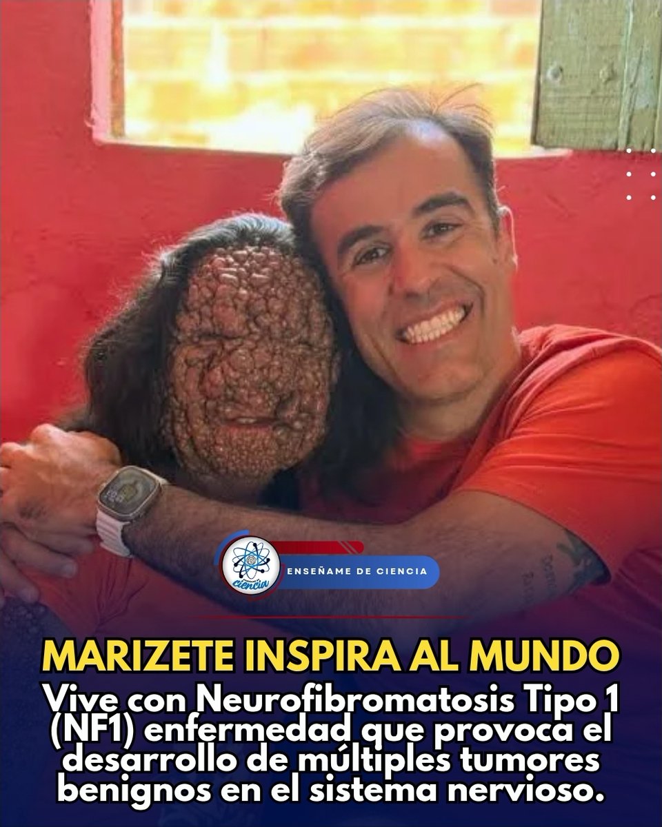 EnsedeCiencia's tweet photo. 🚨Marizete, una mujer de Brasil, esposa y madre de cuatro hijos, vive con Neurofibromatosis Tipo 1 (NF1), una enfermedad genética poco frecuente que provoca el desarrollo de múltiples tumores benignos en el sistema nervioso.

A pesar de los desafíos físicos que enfrenta desde su nacimiento, Marizete continúa luchando cada día por sacar adelante a su familia, convirtiéndose en un símbolo de resiliencia, amor y esperanza.  La NF1 es un trastorno genético raro que requiere seguimiento médico constante y cuyos síntomas pueden variar