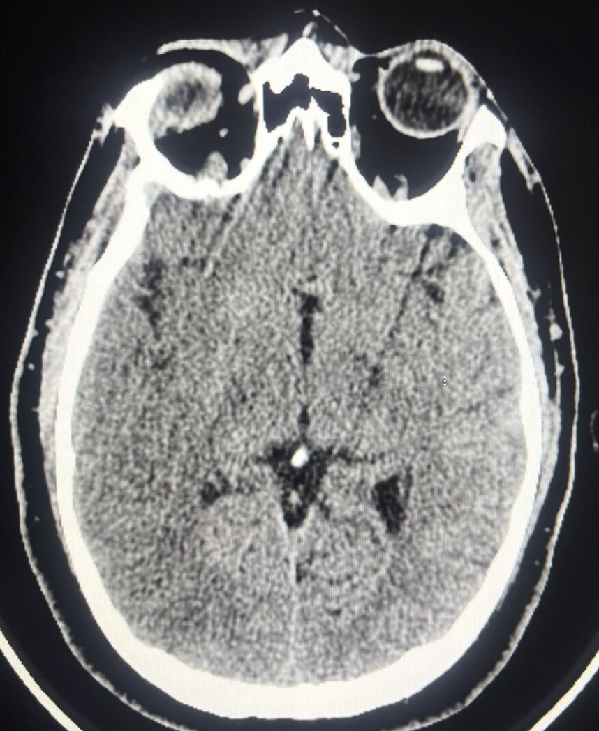 Dr_Refaan's tweet photo. شاب (38 سنة) أُصيب بجلطة دماغية خطيرة بعد ساعات من عملية في القلب. الأشعة تُشير لصعوبة إنقاذه، لكن رفضنا نستسلم.
بناءً على أحدث الأبحاث ولأنه ما زال شاباً، قررنا إجراء قسطرة دماغية عاجلة.. والنتيجة؟ نجحنا في سحب الجلطة وفتح الشريان بالكامل من أول محاولة!
شكرا لكل الفريق الطبي https://t.co/8iyinzylLl