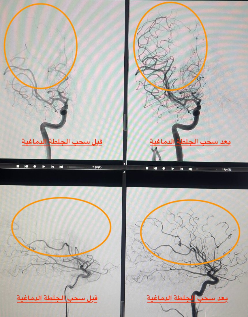 Dr_Refaan's tweet photo. شاب (38 سنة) أُصيب بجلطة دماغية خطيرة بعد ساعات من عملية في القلب. الأشعة تُشير لصعوبة إنقاذه، لكن رفضنا نستسلم.
بناءً على أحدث الأبحاث ولأنه ما زال شاباً، قررنا إجراء قسطرة دماغية عاجلة.. والنتيجة؟ نجحنا في سحب الجلطة وفتح الشريان بالكامل من أول محاولة!
شكرا لكل الفريق الطبي https://t.co/8iyinzylLl
