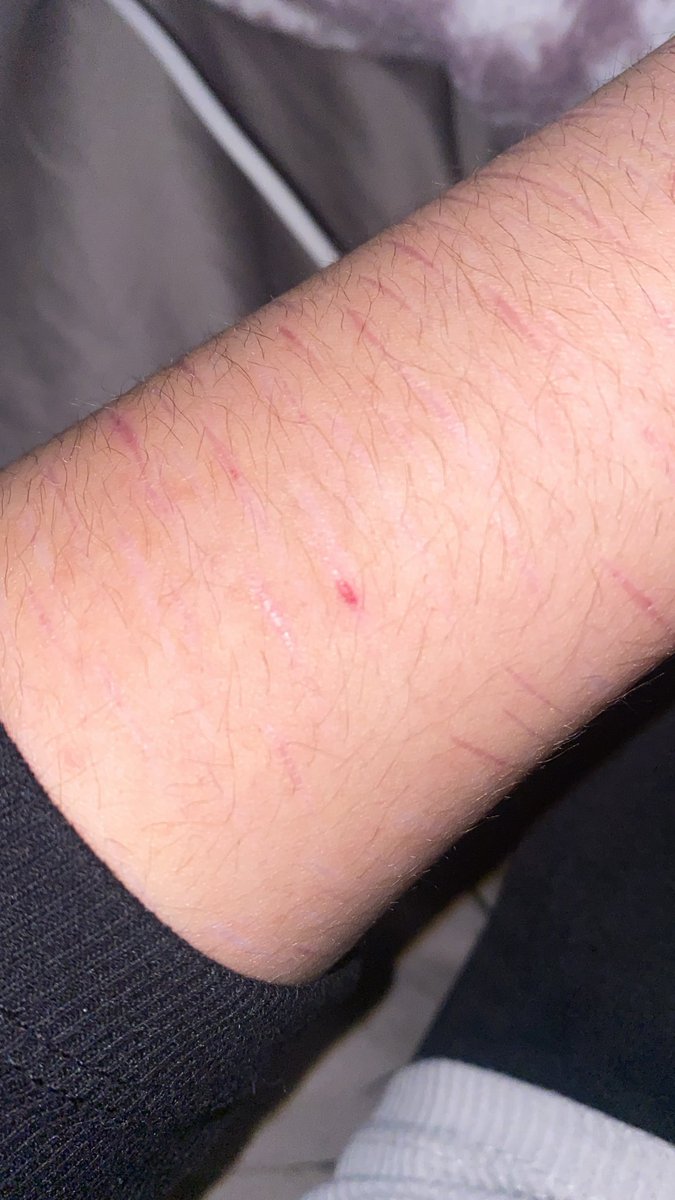 ronicest's tweet photo. why is it red.. fully healed. https://t.co/8ofW6gW1zJ