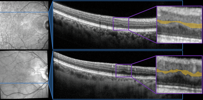 ophthopedia's tweet photo. Ophthopedia Update: Retinal ischemic perivascular lesions in cortical cerebral infarction: a comparison against controls https://t.co/YfaCHUgSAp #Ophthalmology #Eye #Ophthotwitter https://t.co/jebNMlX1c5