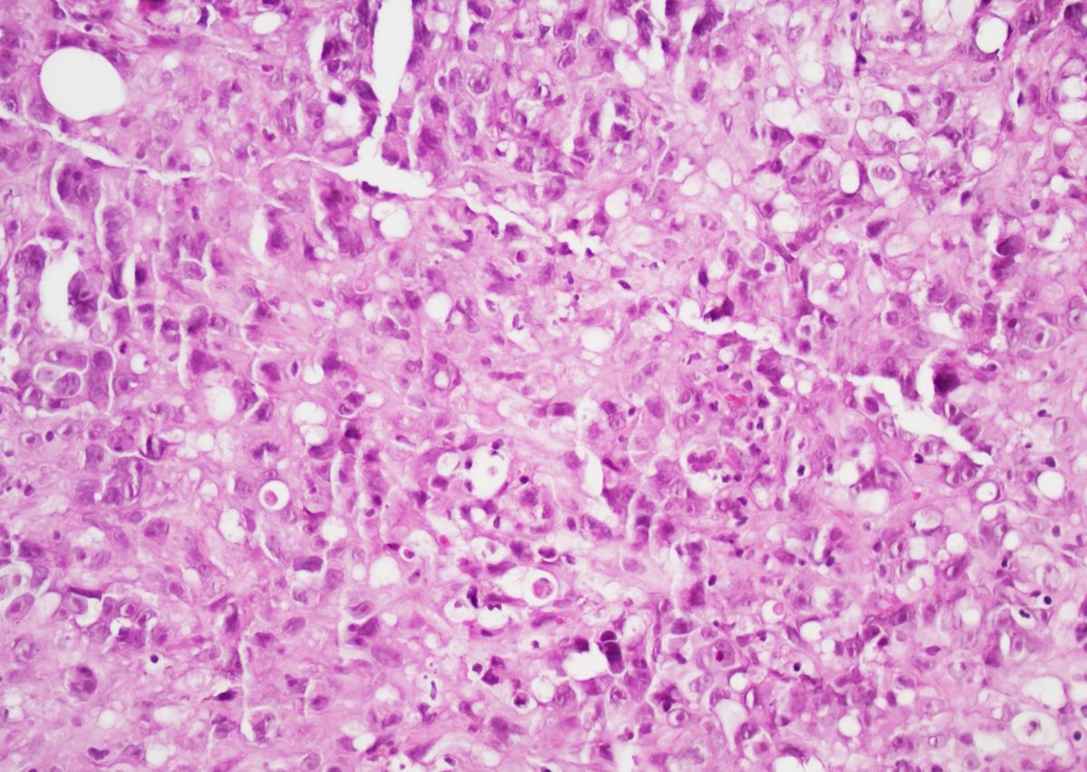 GuannanTiffany's tweet photo. 🧩 Bladder riddle
An evil-looking blood pond. 🩸
Are all epithelioid tumors in the bladder carcinoma of urothelial origin?
What is your diagnosis?
#DxMindMap #BladderPath #GUPath #Mimicker #PathTwitter @JHUpath https://t.co/JVn2a8UaQm
